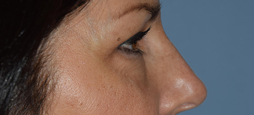 Blepharoplasty