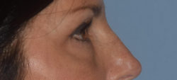 Blepharoplasty