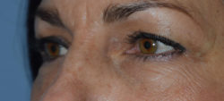 Blepharoplasty