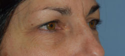 Blepharoplasty