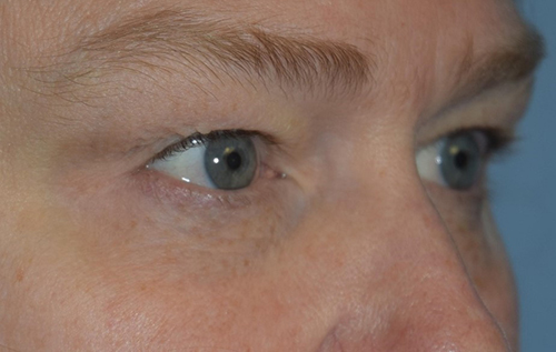 Upper Eyelid Blepharoplasty