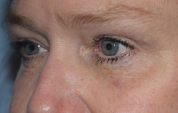 Upper Eyelid Blepharoplasty