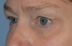 Upper Eyelid Blepharoplasty