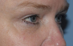 Upper Eyelid Blepharoplasty