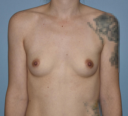 Breast Augmentation