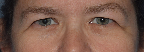 Upper Eyelid Blepharoplasty