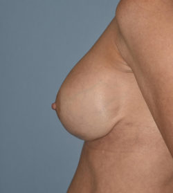 Breast Revision surgery