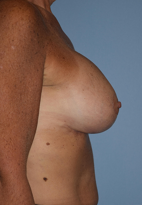 Breast Augmentation