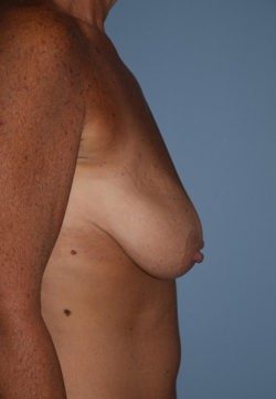 Breast Augmentation