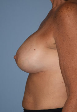 Breast Augmentation