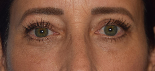 Blepharoplasty