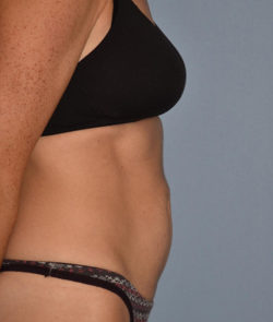 Tummy Tuck