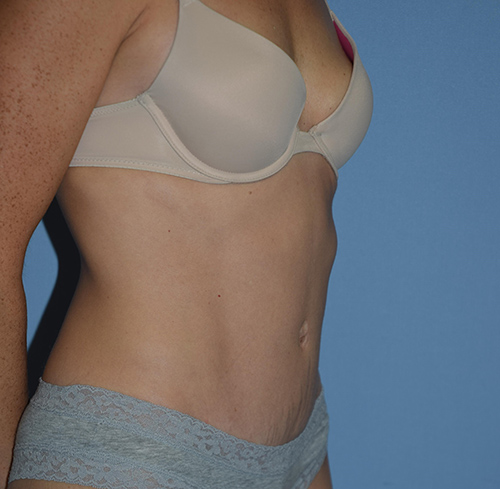 Tummy Tuck