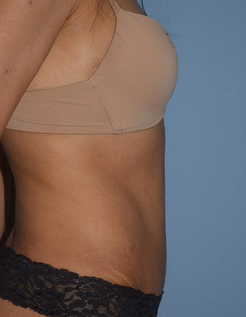 Tummy Tuck