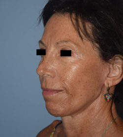 Facelift