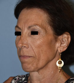 Facelift