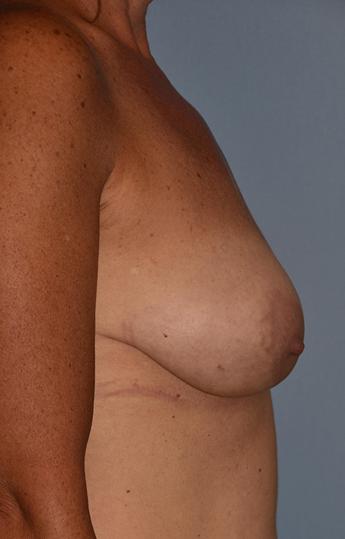 Breast Reconstruction (Implants)