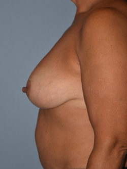 Breast Reduction