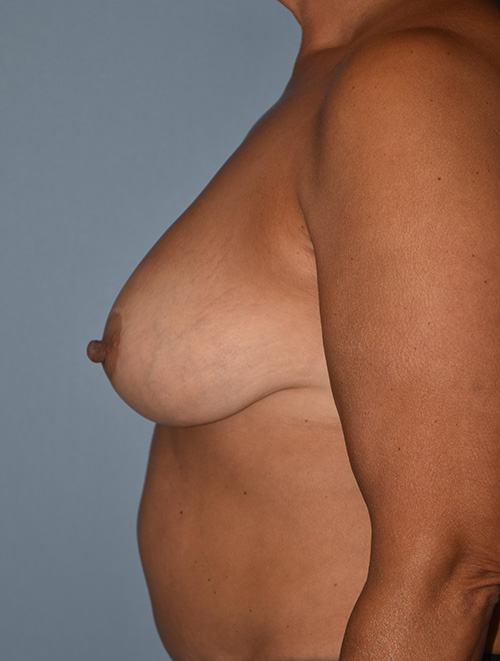 Breast Reduction