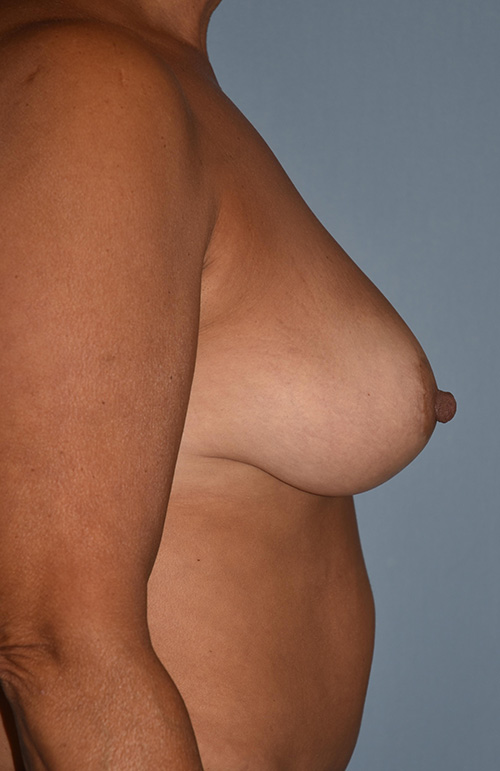 Breast Reduction