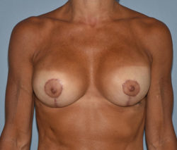 Breast Reconstruction (Implants)