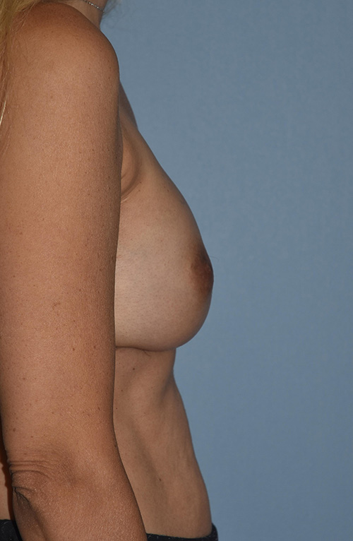 Breast Reconstruction (Implants)