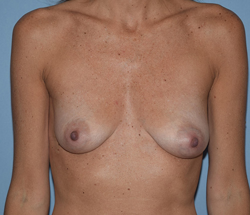 Breast Reconstruction (Implants)