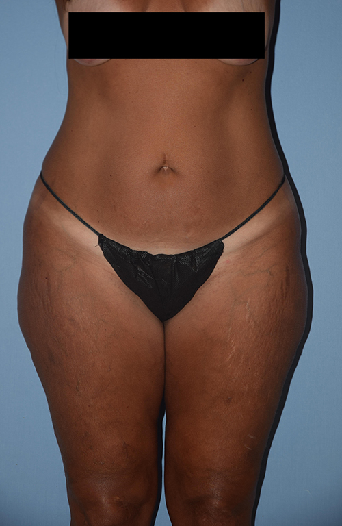 Liposuction