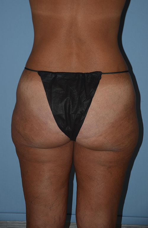 Liposuction