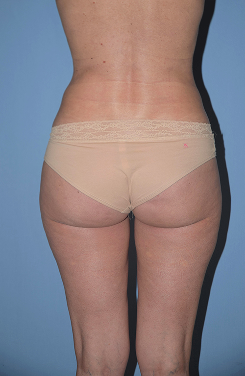 Liposuction