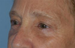 Blepharoplasty