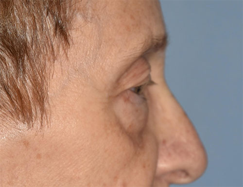 Blepharoplasty