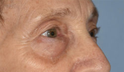 Blepharoplasty