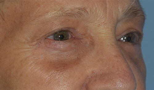 Blepharoplasty