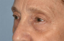 Blepharoplasty