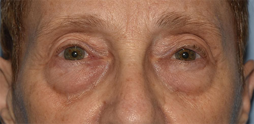 Blepharoplasty