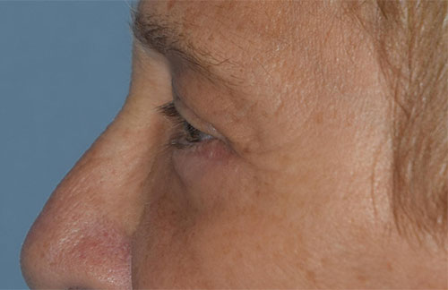 Blepharoplasty