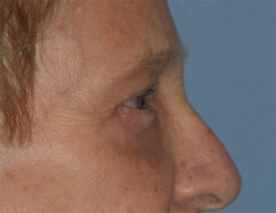 Blepharoplasty