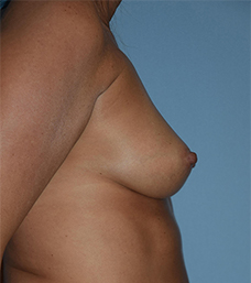 Breast Augmentation