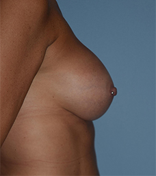 Breast Augmentation