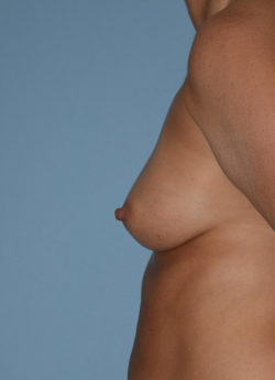 Breast Augmentation