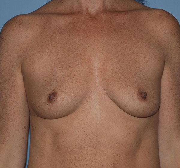 Breast Augmentation