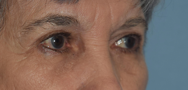 Upper Eyelid Blepharoplasty