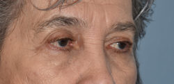 Upper Eyelid Blepharoplasty