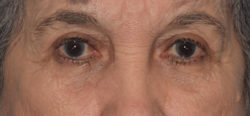 Upper Eyelid Blepharoplasty