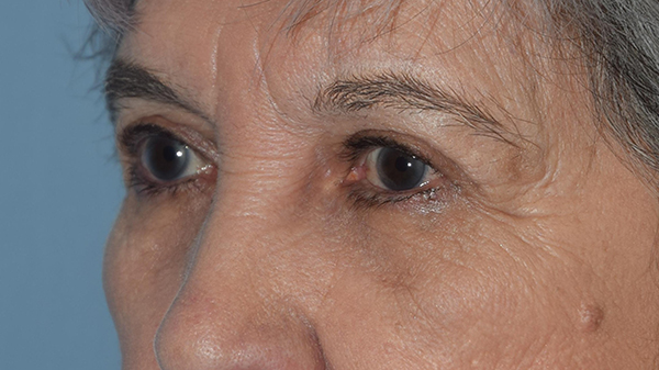 Upper Eyelid Blepharoplasty