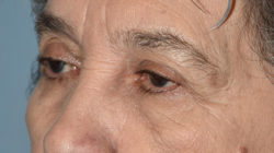 Upper Eyelid Blepharoplasty