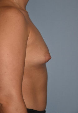 Breast Augmentation