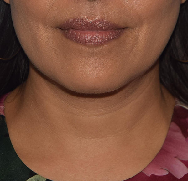 Double Chin Correction