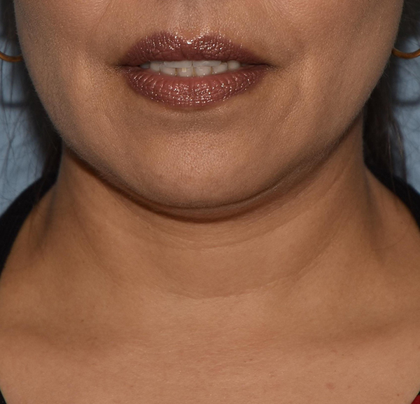 Double Chin Correction